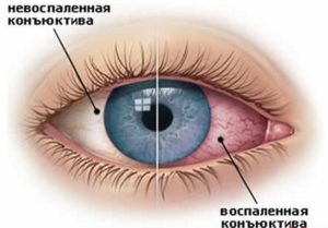 Inflammation of the eye