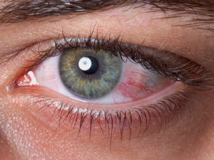 Inflamed eye