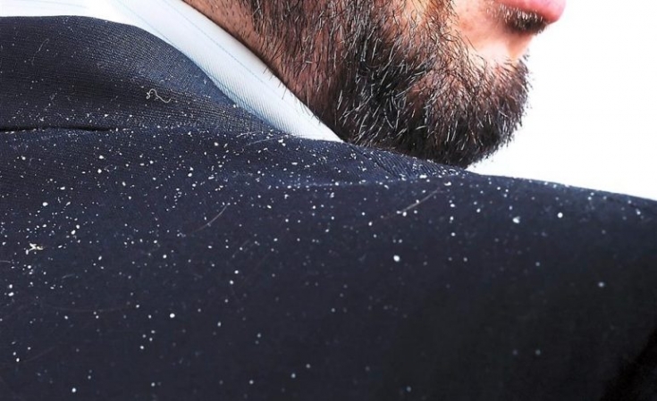 Dandruff